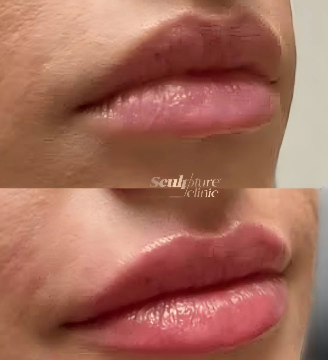 Lip augmentation exclusively available in Sculpture clinic
Lip augmentation is a type of procedure that aims to increase lip fullness through enlargement using fillers such as hyaluronic acid.
Pain level: Tolerable (Local anesthesia)
Recovery: no downtime
📝Note: Individual results may vary
⚠️Caution: Must be performed by an experienced Doctor
Follow us on
📸Instagram: Maged_Rizkallah
♦️Youtube Channel: Dr Maged Rizkallah
For more info and reservations
📧Email: Info@sculpture-clinic.com
🌍Website: www.sculpture-clinic.com
☎️Phone : +20106-292-6666
Due to high calls volume, please leave a message if your call is not answered immediately.
© Copyright 2016-2025 by Dr Maged Rizkallah and Sculpture Clinic
#drmagedrizkallah #sculptureclinic #askDrMaged #celebrity #doctor #lips #lipstick #plumpedlips #makeup #nofilter #picoftheday #instabeauty #cosmeticsurgery #cosmetics #aesthetics #plasticsurgery #bodyart #egypt #beforeandafter #dubai #paris #ksa #nyc #miami #fillers #beauty