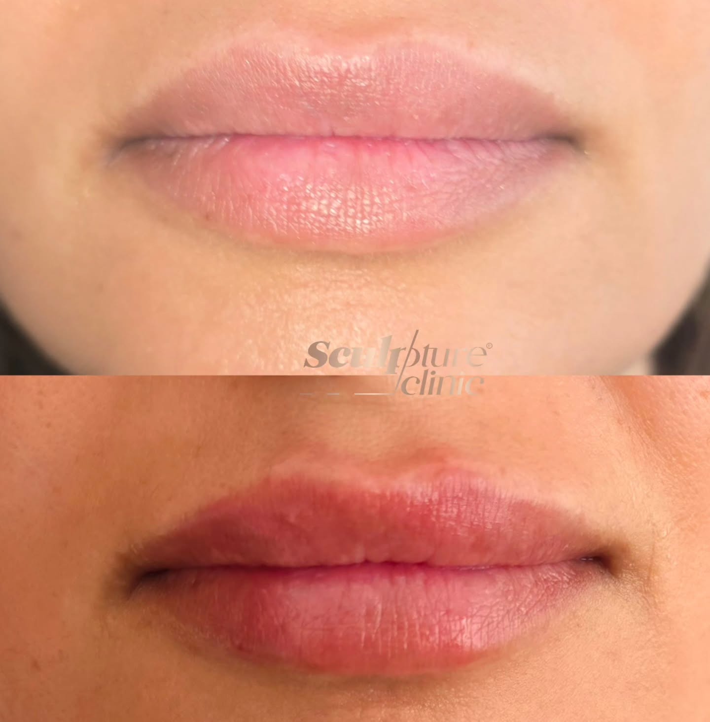 Hydrated & healthy
Hyaluronic acid-based fillers keep your lips hydrated and healthy-looking. Exclusively available in Sculpture clinic
Pain level: Tolerable (Local anesthesia)
Recovery: no downtime
📝Note: Individual results may vary
⚠️Caution: Must be performed by an experienced Doctor
Follow us on
📸Instagram: Maged_Rizkallah
♦️Youtube Channel: Dr Maged Rizkallah
For more info and reservations
📧Email: Info@sculpture-clinic.com
🌍Website: www.sculpture-clinic.com
☎️Phone : +20106-292-6666
Due to high calls volume, please leave a message if your call is not answered immediately.
© Copyright 2016-2025 by Dr Maged Rizkallah and Sculpture Clinic
#LipFillers #LipAugmentation #LipInjections
#LipEnhancement #FullerLips #VoluptuousLips
#KissableLips #LipGoals #LipTransformation #LipFillerResults #LipFillerBeforeAndAfter
#LipFillerJourney #LipFillerLove #LipFillerAddict
#LipFillerQueen #NaturalLipFillers #SafeLipFillers #LipFillerSpecialist #LipFillerClinic #lipfillerdeals #LipFillerSpecial #askdrmaged