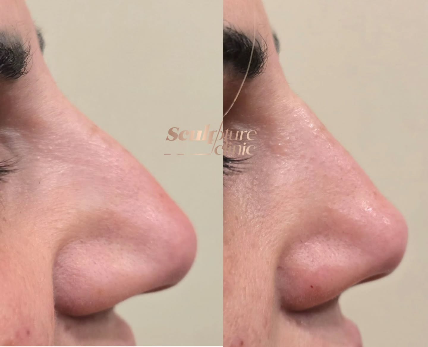 5 mins Nose job for a more refined and balanced profile
Exclusively available in Sculpture clinic
Pain level: Tolerable (Local anesthesia)
Recovery: no downtime
📝Note: Individual results may vary
⚠️Caution: Must be performed by an experienced Doctor
Follow us on
📸Instagram: Maged_Rizkallah
♦️Youtube Channel: Dr Maged Rizkallah
For more info and reservations
📧Email: Info@sculpture-clinic.com
🌍Website: www.sculpture-clinic.com
☎️Phone : +20106-292-6666
Due to high calls volume, please leave a message if your call is not answered immediately.
© Copyright 2016-2025 by Dr Maged Rizkallah and Sculpture Clinic
#sculptureclinic #drmagedrizkallah #askDrMaged #nose #nonsurgical #beauty #beautiful #NonsurgicalNoseFiller
#NonInvasiveRhinoplasty
#NoseEnhancementWithoutSurgery
#LiquidRhinoplasty
#HyaluronicAcidNoseFillers
#NoseFillerTransformation
#NaturalNoseContouring
#SafeNoseAugmentation
#ImprovedNasalProfile
#SubtleNoseReshaping
#PainFreeNoseJob