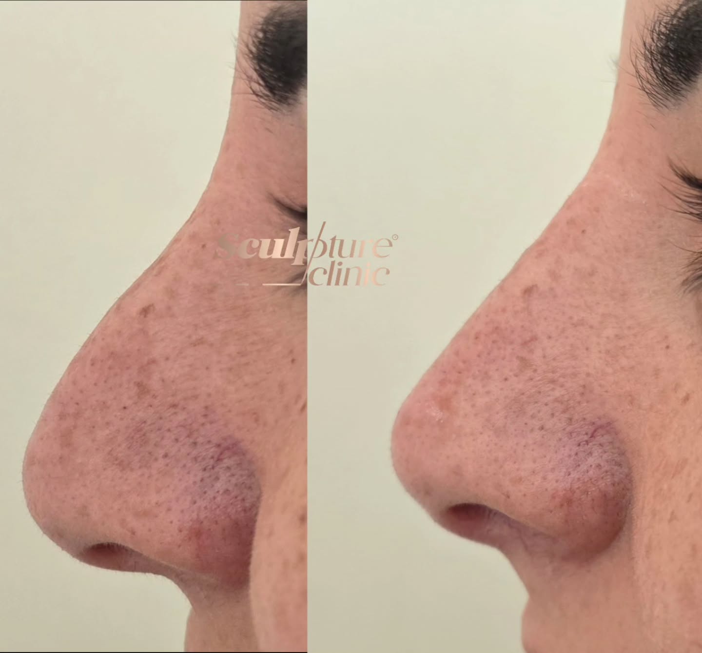 5 mins Nose job for a more refined and balanced profile
Exclusively available in Sculpture clinic
Pain level: Tolerable (Local anesthesia)
Recovery: no downtime
📝Note: Individual results may vary
⚠️Caution: Must be performed by an experienced Doctor
Follow us on
📸Instagram: Maged_Rizkallah
♦️Youtube Channel: Dr Maged Rizkallah
For more info and reservations
📧Email: Info@sculpture-clinic.com
🌍Website: www.sculpture-clinic.com
☎️Phone : +20106-292-6666
Due to high calls volume, please leave a message if your call is not answered immediately.
© Copyright 2016-2025 by Dr Maged Rizkallah and Sculpture Clinic
#sculptureclinic #drmagedrizkallah #askDrMaged #nose #nonsurgical #beauty #beautiful #NonsurgicalNoseFiller
#NonInvasiveRhinoplasty
#NoseEnhancementWithoutSurgery
#LiquidRhinoplasty
#HyaluronicAcidNoseFillers
#NoseFillerTransformation
#NaturalNoseContouring
#SafeNoseAugmentation
#ImprovedNasalProfile
#SubtleNoseReshaping
#PainFreeNoseJob