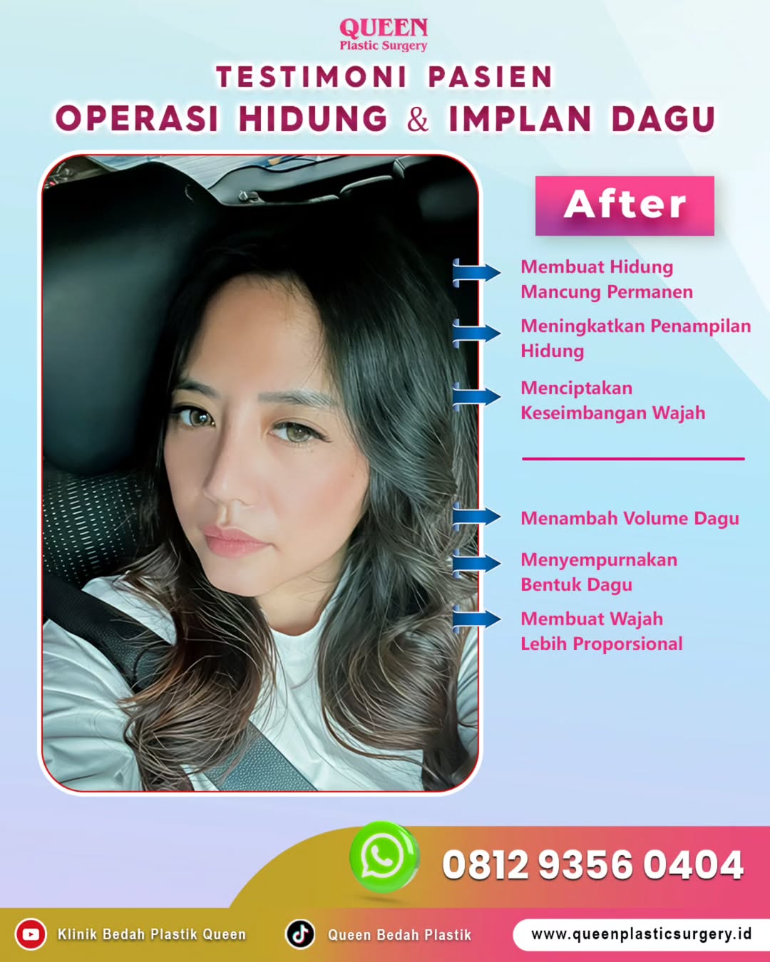 Ingin hidung lebih mancung dan wajah lebih proporsional? Queen Plastic Surgery punya solusinya!
Pasien kami telah membuktikan hasilnya dengan Operasi Hidung & Implan Dagu. Rasakan perubahan pada hidung Anda menjadi lebih mancung permanen, penampilan lebih menarik, dan dagu yang bervolume sempurna.
#QueenPlasticSurgery
#KlinikBedahPlastikQueen
#OperasiHidung
#ImplanDagu
#BedahPlastik
#EstetikaWajah
#kecantikan