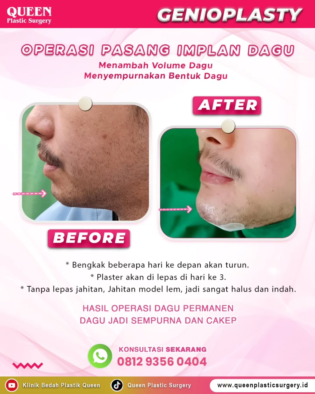Ingin memiliki dagu yang lebih proporsional dan menawan?
Temukan solusi sempurna dengan Genioplasty (Operasi Pasang Implan Dagu) di Queen Plastic Surgery!
Prosedur ini dirancang khusus untuk menambah volume dagu dan menyempurnakan bentuk dagu Anda, memberikan hasil permanen yang cakep dan ideal.
Di Queen Plastic Surgery, kenyamanan dan hasil optimal Anda adalah prioritas kami. Pasca-operasi, pembengkakan akan berangsur turun dalam beberapa hari, dan plester akan dilepas pada hari ke-3. Yang terbaik, kami menggunakan jahitan model lem, sehingga tidak perlu lepas jahitan dan hasilnya sangat halus serta indah!
Siap memiliki dagu impian? Jangan lewatkan kesempatan ini!
KONSULTASI SEKARANG: 📞 0812 9356 0404
Kunjungi kami di:
#OperasiDagu #ImplanDagu #BedahPlastik #QueenPlasticSurgery #DaguIdeal #DaguMancung #KecantikanWajah #Estetika #PerawatanKecantikan #BedahPlastikJakarta #KlinikKecantikan #TransformasiWajah #ProsedurEstetika #DaguSempurna #ChinAugmentation #PlasticSurgeryIndonesia #BeautyTransformation #HasilPermanen #KonsultasiGratis"
