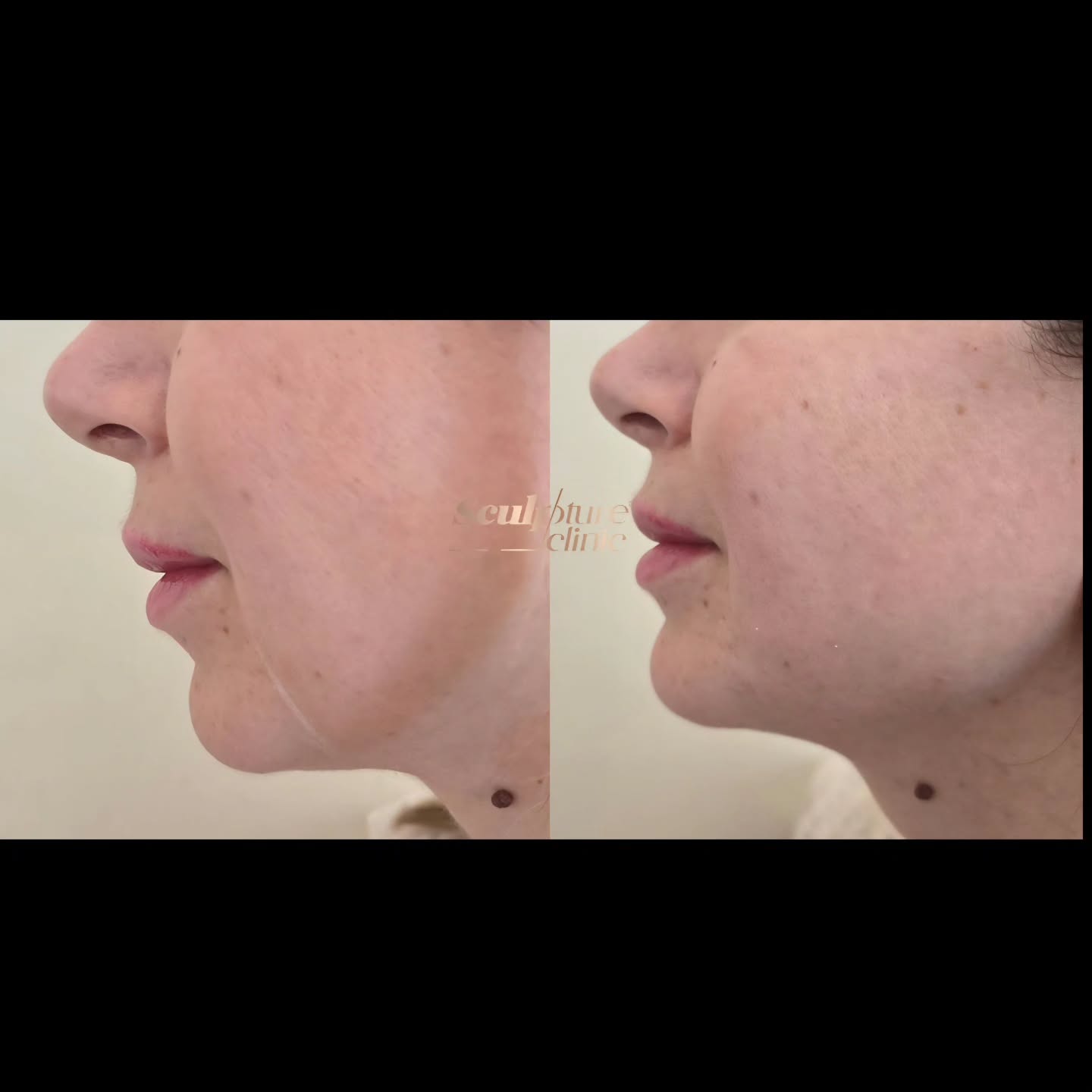 We pay careful attention to the nuances of facial anatomy, sculpting the jawline with precision to enhance facial harmony and balance. Our goal is to create subtle yet impactful enhancements that complement the client’s natural features.
📝Note: Individual results may vary
⚠️Caution: Must be performed by an experienced Doctor
Follow us on
📸Instagram: Maged_Rizkallah
♦️Youtube Channel: Dr Maged Rizkallah
For more info and reservations
📧Email: Info@sculpture-clinic.com
🌍Website: www.sculpture-clinic.com
☎️Phone : +20106-292-6666
Due to high calls volume, please leave a message if your call is not answered immediately.
© Copyright 2016-2025 by Dr Maged Rizkallah , and Sculpture Clinic
#drmagedrizkallah #askDrMaged #sculptureclinic #morning #motivation #beauty #happy #patient #doctor #cosmeticsurgery #cosmetics #aesthetics #plasticsurgery #picoftheday
#JawlineFillers #JawlineEnhancement #MaleFacialAesthetics #NonSurgicalJawline #SculptedJawline #DefinedJawline #ChiseledProfile #MasculineContours #FacialHarmony #AestheticGoals #ConfidenceBoost #FillerInjection #JawlineDefinition #JawlineSculpting #JawlineTransformation