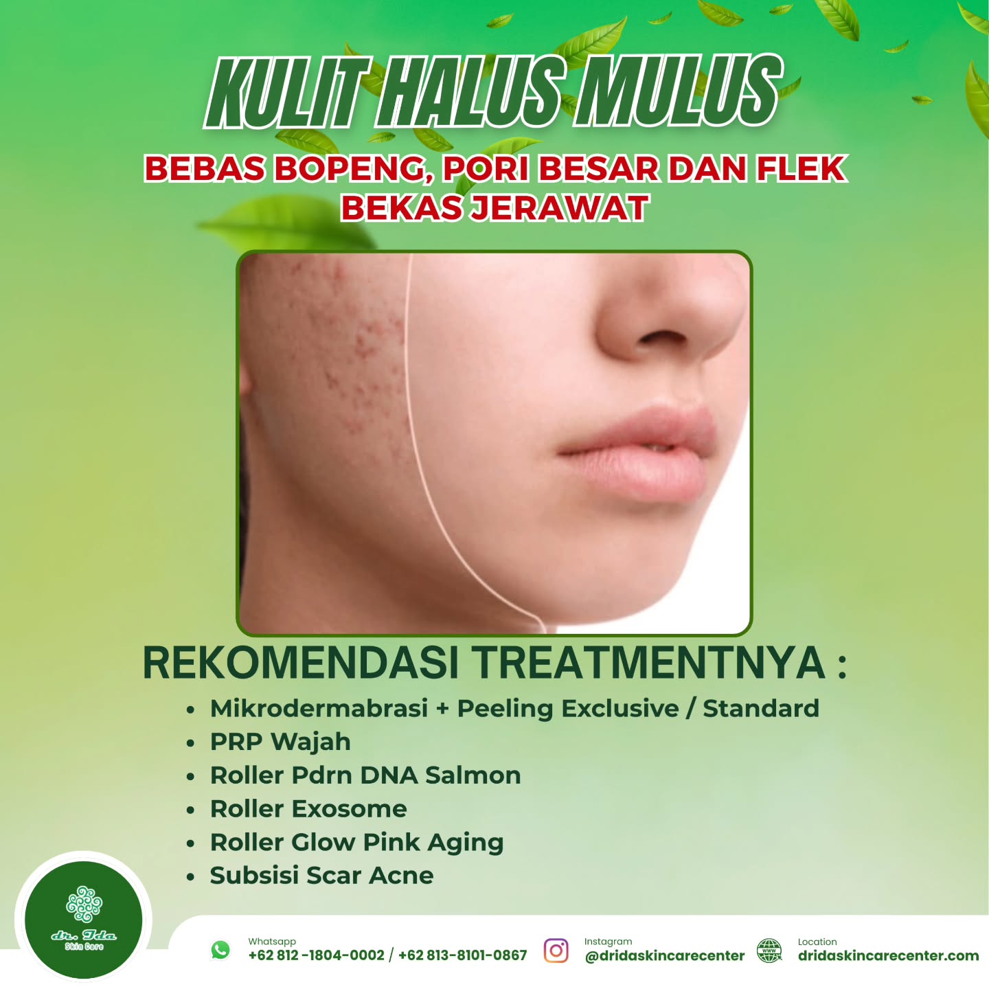 {REKOMENDASI TREATMENT BOPENG PORI BESAR}
Untuk pejuang mantan jerawat yang masih memiliki masalah :
*Bopeng bekas jerawat
*Flek hitam / kemerahan bekas jerawat
*Pori - pori besar
Jangan pernah menyerah yuuk... Sekalipun perlu waktu dan proses yang panjang untuk mengatasi masalahmu di atas, segera ambil pilihan treatment di atas melalui konsultasi dokter.
Disertai pemakaian rutin produk paket series scar acne dr Ida Skin Care, dapatkan kulit sehat, halus mulus tanpa drama, bebas bopeng, bebas pori besar, dan bebas flek hitam atau kemerahan bekas jerawat.....
✨️🥳🎉⚘️🤗
#dridaskincare#klinikkecantikanbogor#produkamanbpom#perawatanwajah#pilihantreatmentbopeng#treatmentporibesar#treatmentflekbekasjerawat#bebasflek#bebaspporibesar#bebasscaracne#kulitsehat#kulitbersinar#kulitglowing#menyala